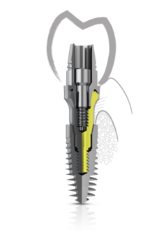 Illustrazione ufficiale Advan del Gingival Former Abutment